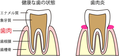 歯肉炎