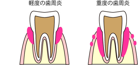 歯周炎