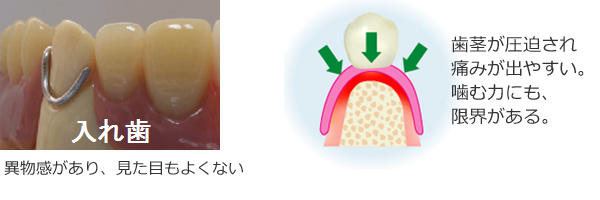 入れ歯